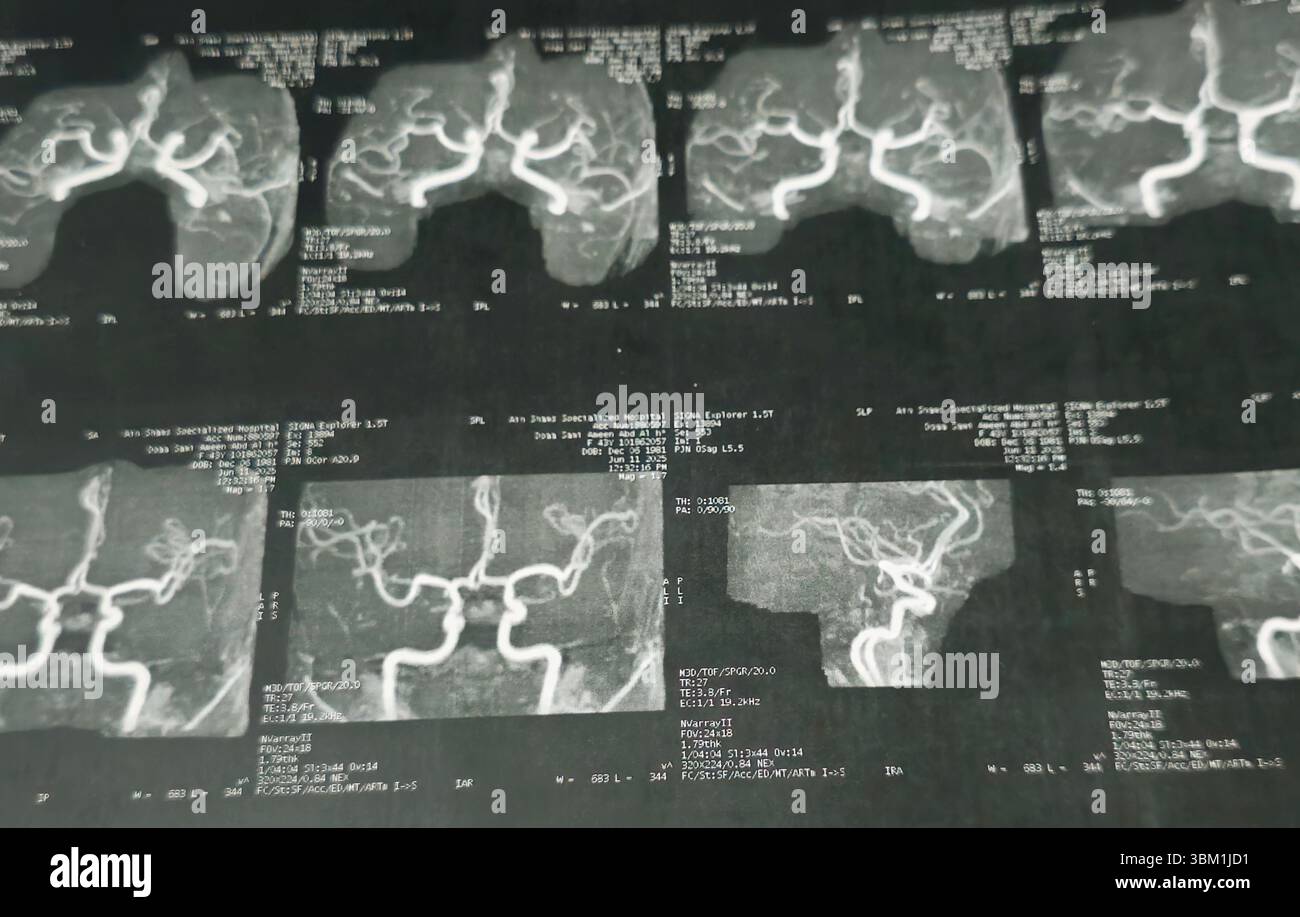 Le Caire, Égypte, 17 juin 2025 : IRM MRA Brain montre peu de petits foyers discrets de substance blanche bilatérale dispersés de signal altéré vu apprécier si lumineux Banque D'Images