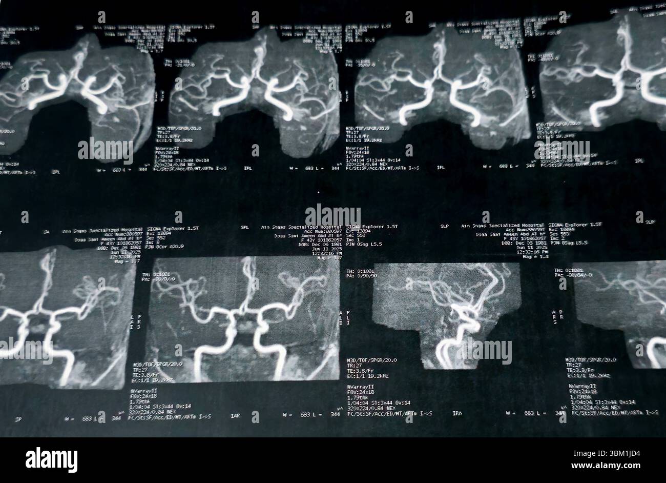 Le Caire, Égypte, 17 juin 2025 : IRM MRA Brain montre peu de petits foyers discrets de substance blanche bilatérale dispersés de signal altéré vu apprécier si lumineux Banque D'Images