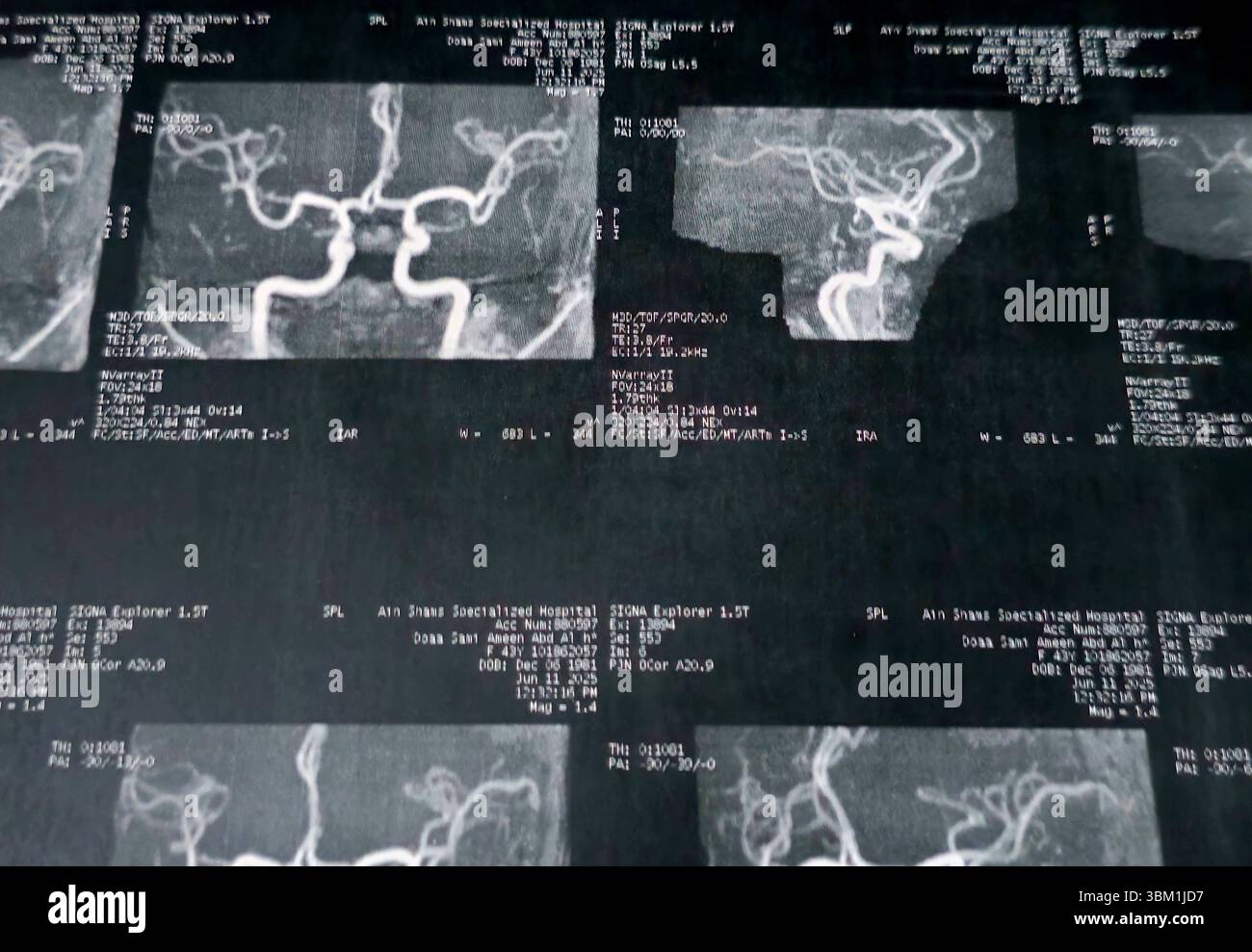 Le Caire, Égypte, 17 juin 2025 : IRM MRA Brain montre peu de petits foyers discrets de substance blanche bilatérale dispersés de signal altéré vu apprécier si lumineux Banque D'Images