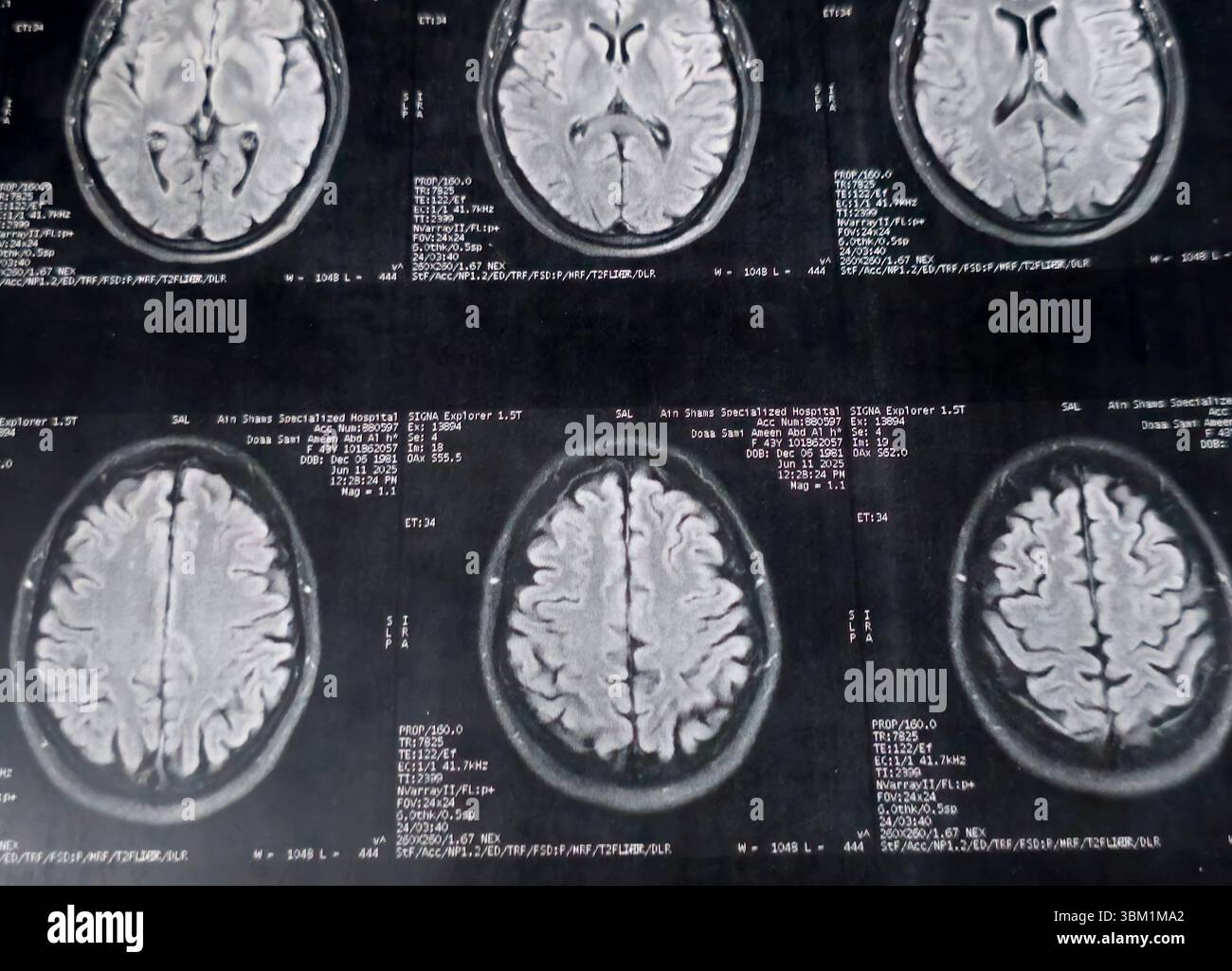 Le Caire, Égypte, 17 juin 2025 : IRM MRA Brain montre peu de petits foyers discrets de substance blanche bilatérale dispersés de signal altéré vu apprécier si lumineux Banque D'Images