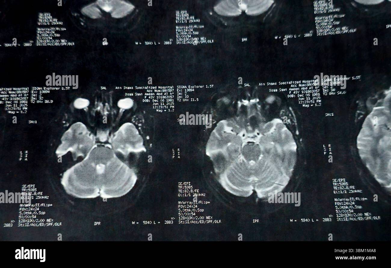 Le Caire, Égypte, 17 juin 2025 : IRM MRA Brain montre peu de petits foyers discrets de substance blanche bilatérale dispersés de signal altéré vu apprécier si lumineux Banque D'Images