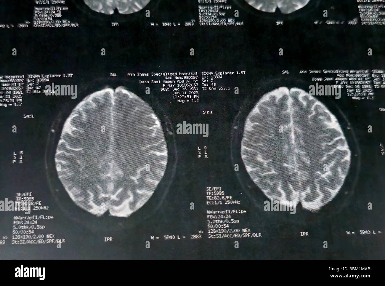 Le Caire, Égypte, 17 juin 2025 : IRM MRA Brain montre peu de petits foyers discrets de substance blanche bilatérale dispersés de signal altéré vu apprécier si lumineux Banque D'Images