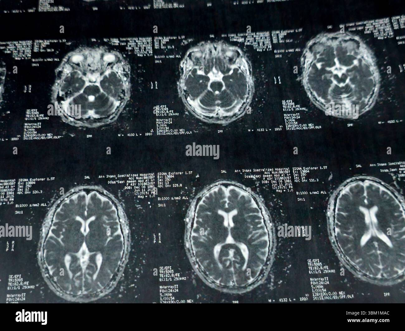 Le Caire, Égypte, 17 juin 2025 : IRM MRA Brain montre peu de petits foyers discrets de substance blanche bilatérale dispersés de signal altéré vu apprécier si lumineux Banque D'Images