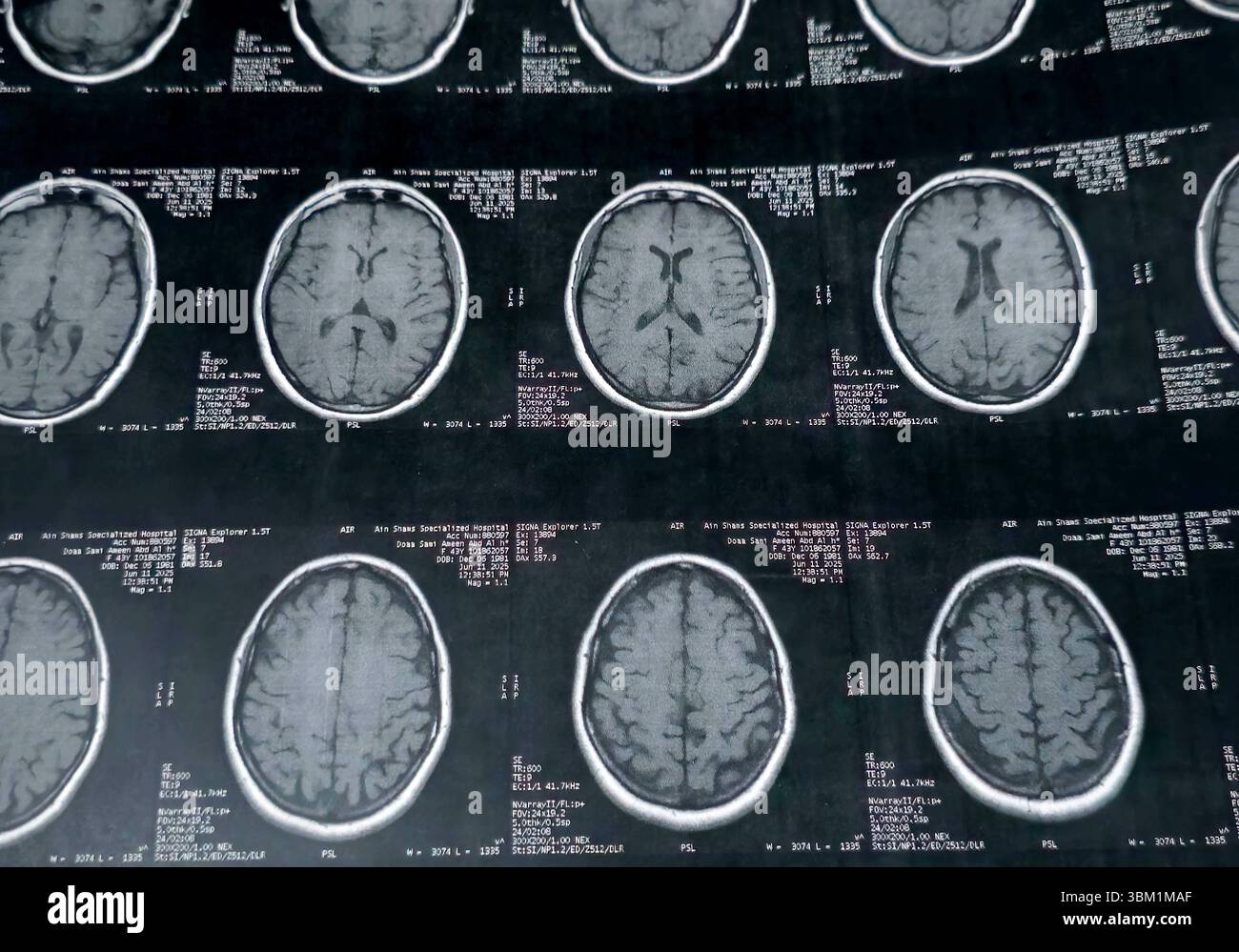 Le Caire, Égypte, 17 juin 2025 : IRM MRA Brain montre peu de petits foyers discrets de substance blanche bilatérale dispersés de signal altéré vu apprécier si lumineux Banque D'Images