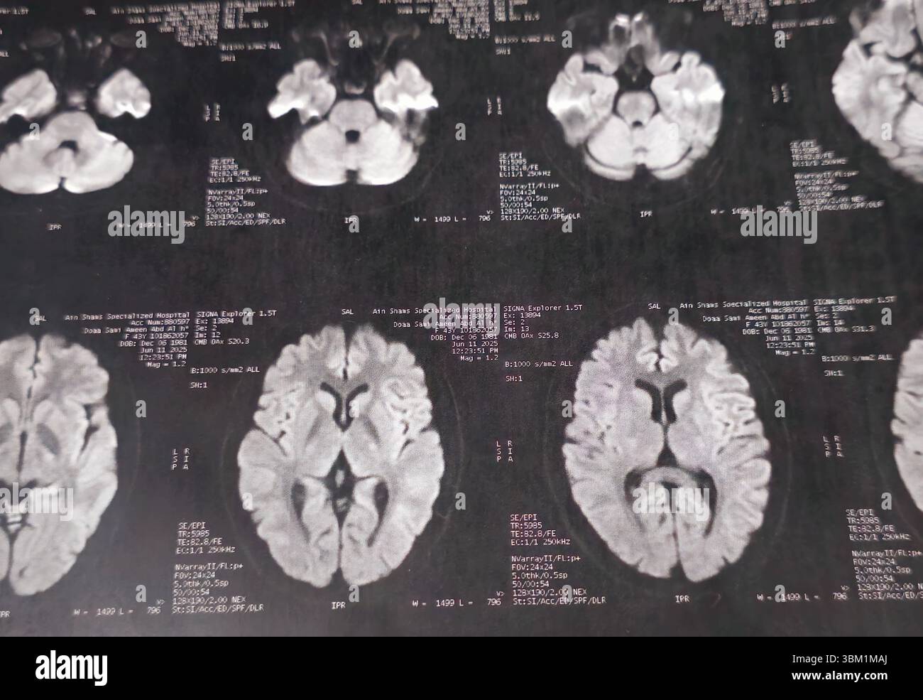 Le Caire, Égypte, 17 juin 2025 : IRM MRA Brain montre peu de petits foyers discrets de substance blanche bilatérale dispersés de signal altéré vu apprécier si lumineux Banque D'Images