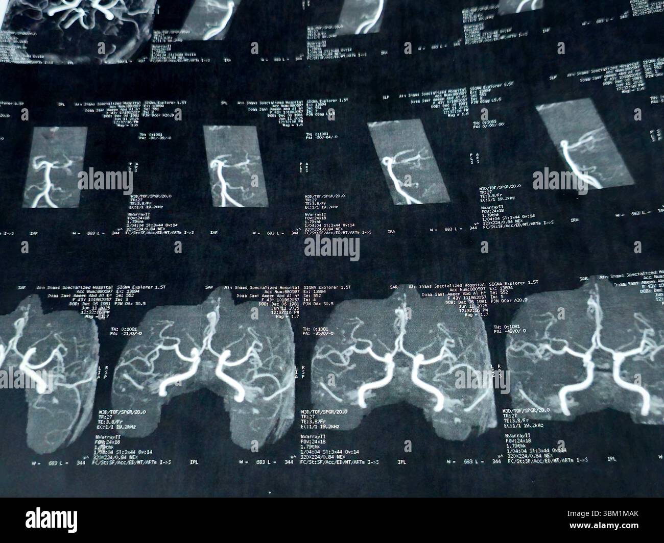 Le Caire, Égypte, 17 juin 2025 : IRM MRA Brain montre peu de petits foyers discrets de substance blanche bilatérale dispersés de signal altéré vu apprécier si lumineux Banque D'Images