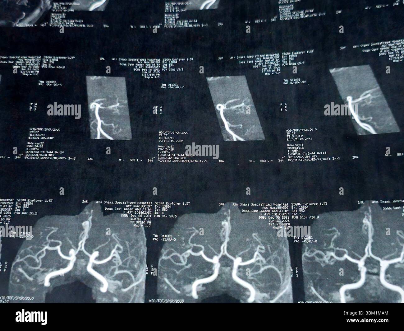 Le Caire, Égypte, 17 juin 2025 : IRM MRA Brain montre peu de petits foyers discrets de substance blanche bilatérale dispersés de signal altéré vu apprécier si lumineux Banque D'Images