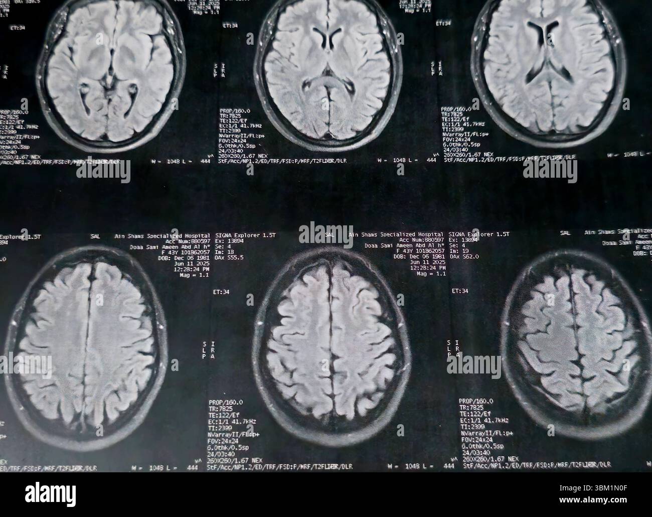 Le Caire, Égypte, 17 juin 2025 : IRM MRA Brain montre peu de petits foyers discrets de substance blanche bilatérale dispersés de signal altéré vu apprécier si lumineux Banque D'Images