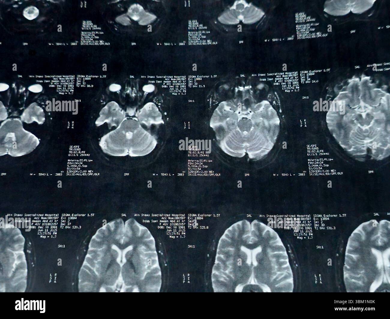 Le Caire, Égypte, 17 juin 2025 : IRM MRA Brain montre peu de petits foyers discrets de substance blanche bilatérale dispersés de signal altéré vu apprécier si lumineux Banque D'Images
