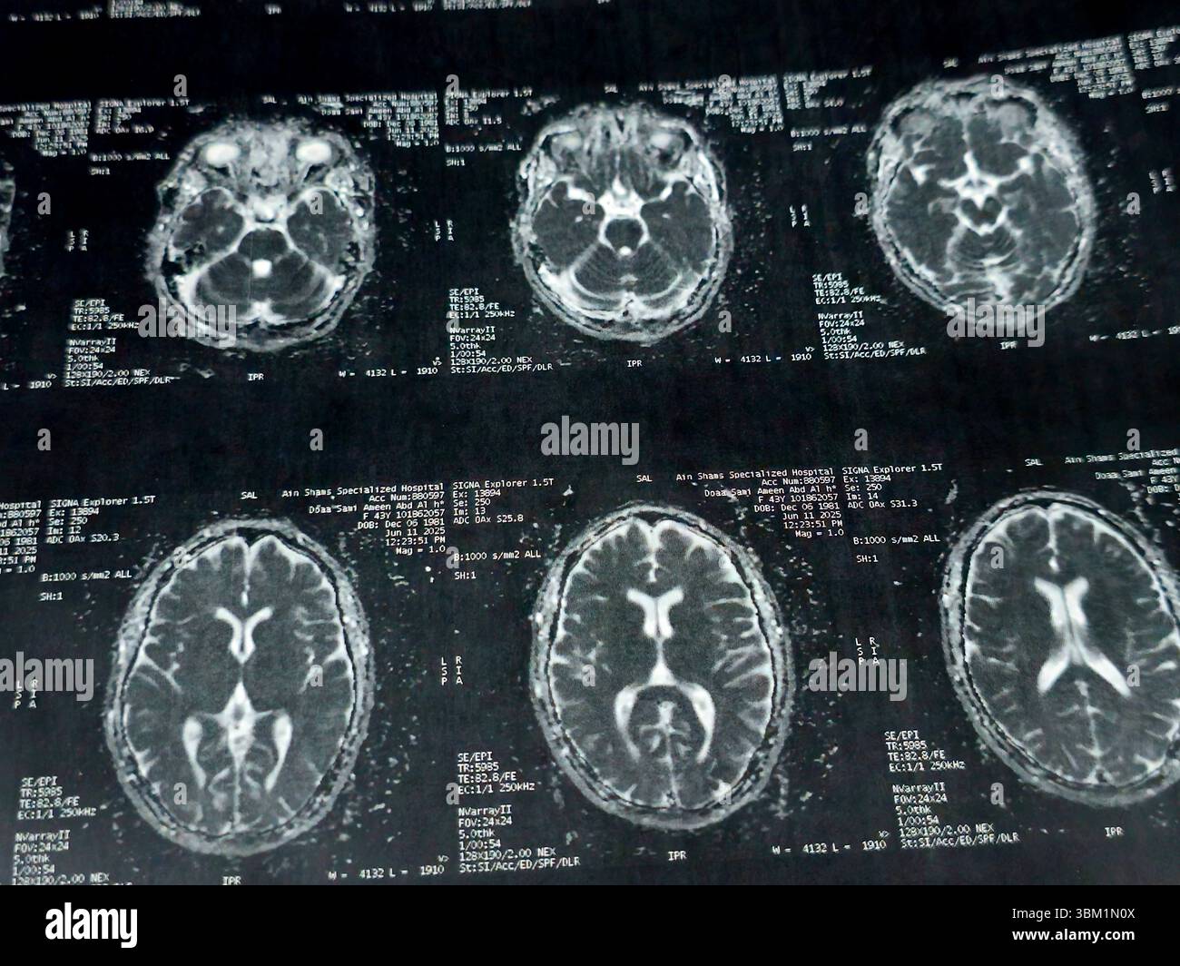 Le Caire, Égypte, 17 juin 2025 : IRM MRA Brain montre peu de petits foyers discrets de substance blanche bilatérale dispersés de signal altéré vu apprécier si lumineux Banque D'Images