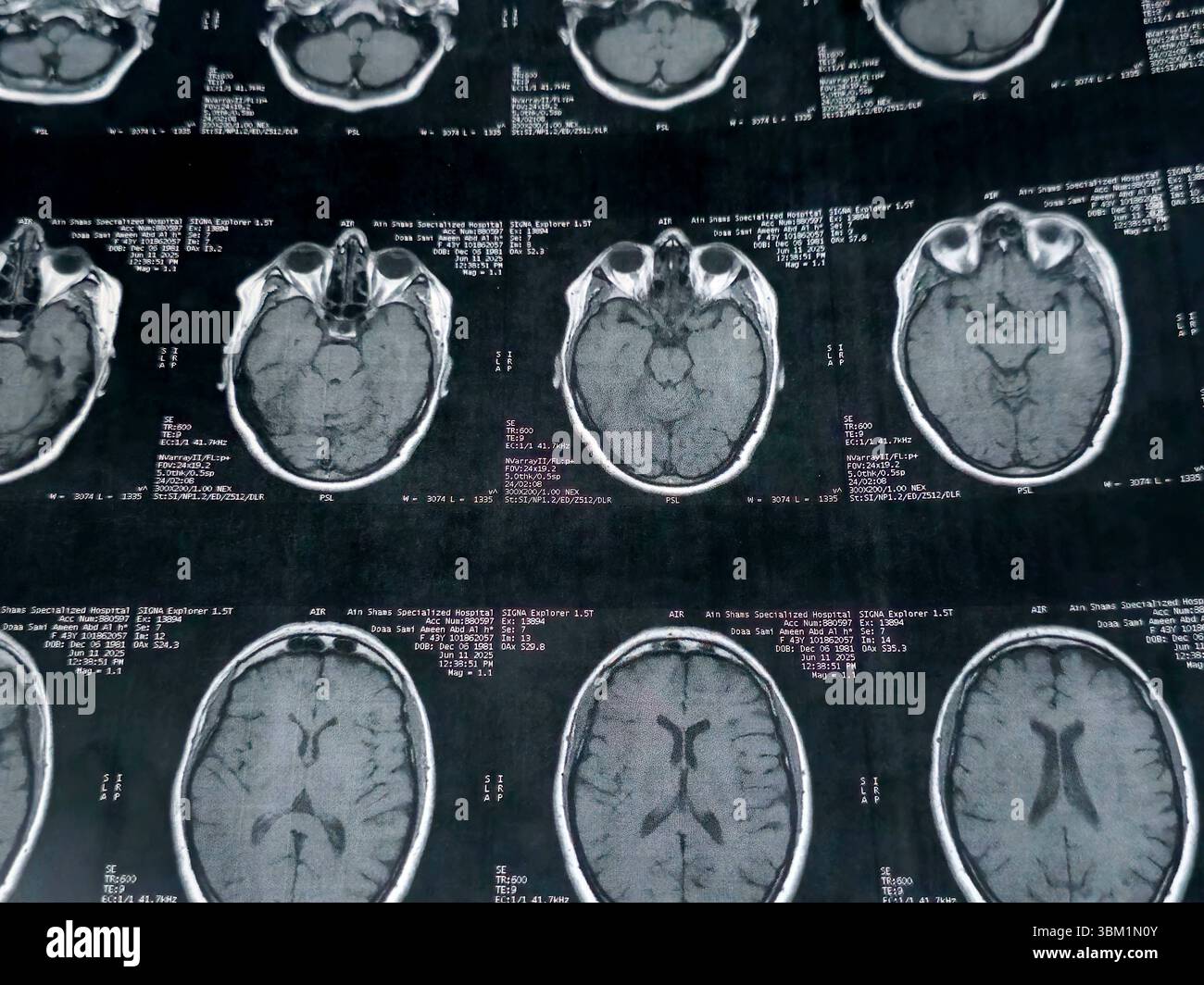 Le Caire, Égypte, 17 juin 2025 : IRM MRA Brain montre peu de petits foyers discrets de substance blanche bilatérale dispersés de signal altéré vu apprécier si lumineux Banque D'Images