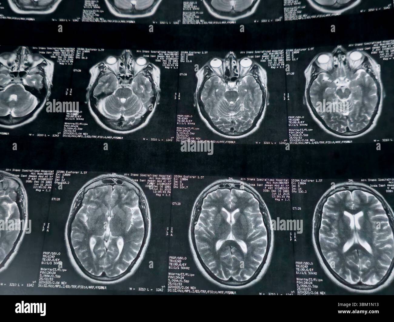 Le Caire, Égypte, 17 juin 2025 : IRM MRA Brain montre peu de petits foyers discrets de substance blanche bilatérale dispersés de signal altéré vu apprécier si lumineux Banque D'Images