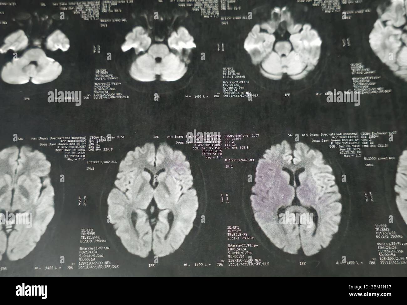 Le Caire, Égypte, 17 juin 2025 : IRM MRA Brain montre peu de petits foyers discrets de substance blanche bilatérale dispersés de signal altéré vu apprécier si lumineux Banque D'Images