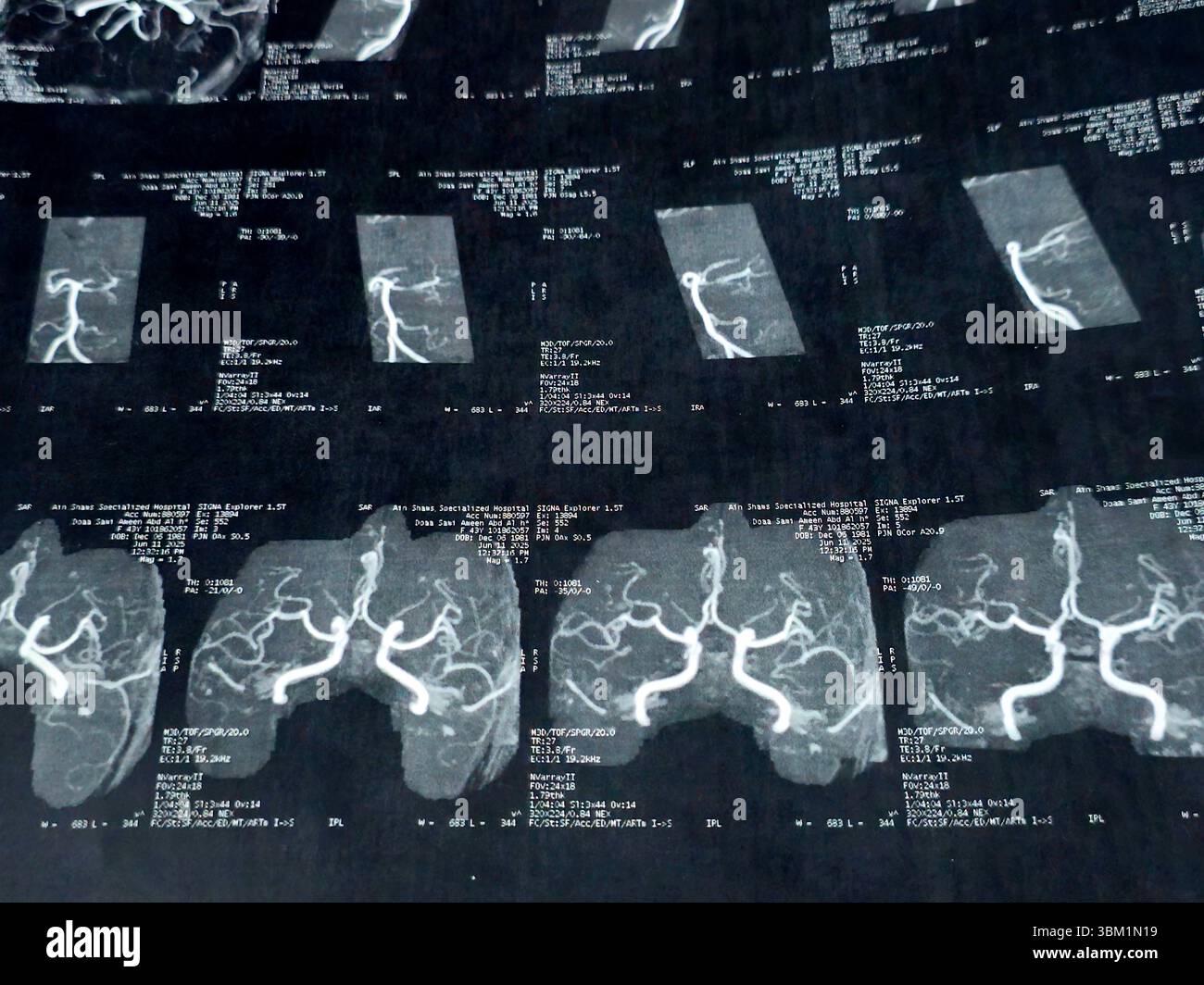 Le Caire, Égypte, 17 juin 2025 : IRM MRA Brain montre peu de petits foyers discrets de substance blanche bilatérale dispersés de signal altéré vu apprécier si lumineux Banque D'Images