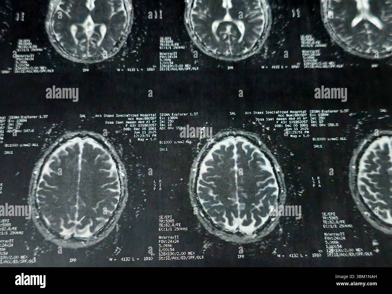 Le Caire, Égypte, 17 juin 2025 : IRM MRA Brain montre peu de petits foyers discrets de substance blanche bilatérale dispersés de signal altéré vu apprécier si lumineux Banque D'Images