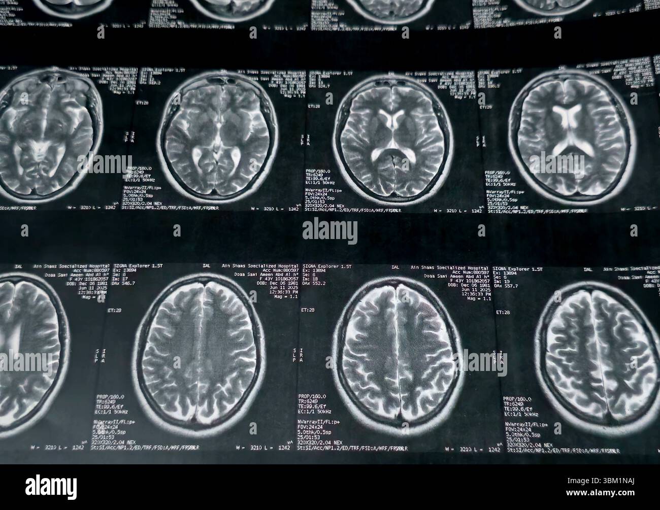 Le Caire, Égypte, 17 juin 2025 : IRM MRA Brain montre peu de petits foyers discrets de substance blanche bilatérale dispersés de signal altéré vu apprécier si lumineux Banque D'Images