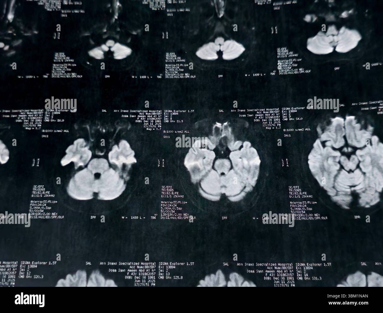 Le Caire, Égypte, 17 juin 2025 : IRM MRA Brain montre peu de petits foyers discrets de substance blanche bilatérale dispersés de signal altéré vu apprécier si lumineux Banque D'Images