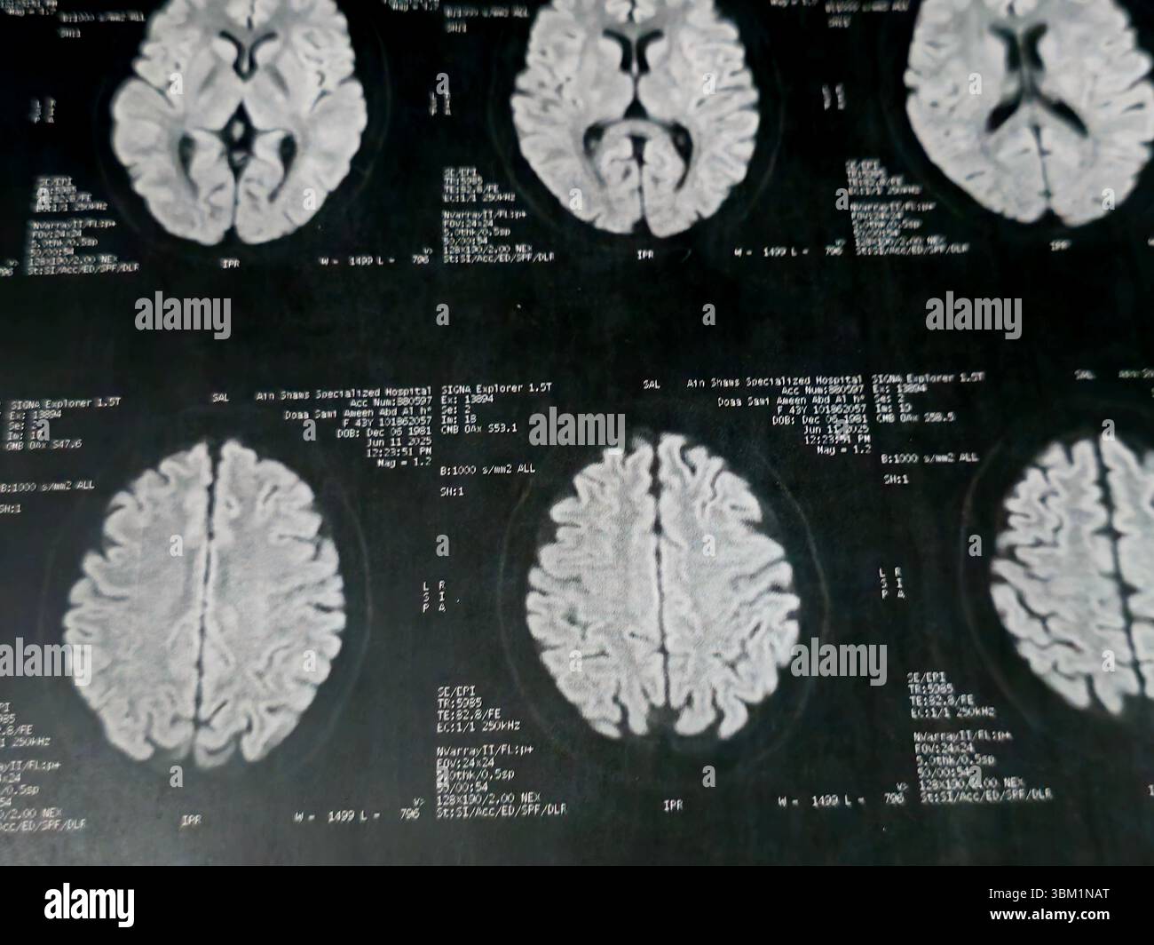 Le Caire, Égypte, 17 juin 2025 : IRM MRA Brain montre peu de petits foyers discrets de substance blanche bilatérale dispersés de signal altéré vu apprécier si lumineux Banque D'Images