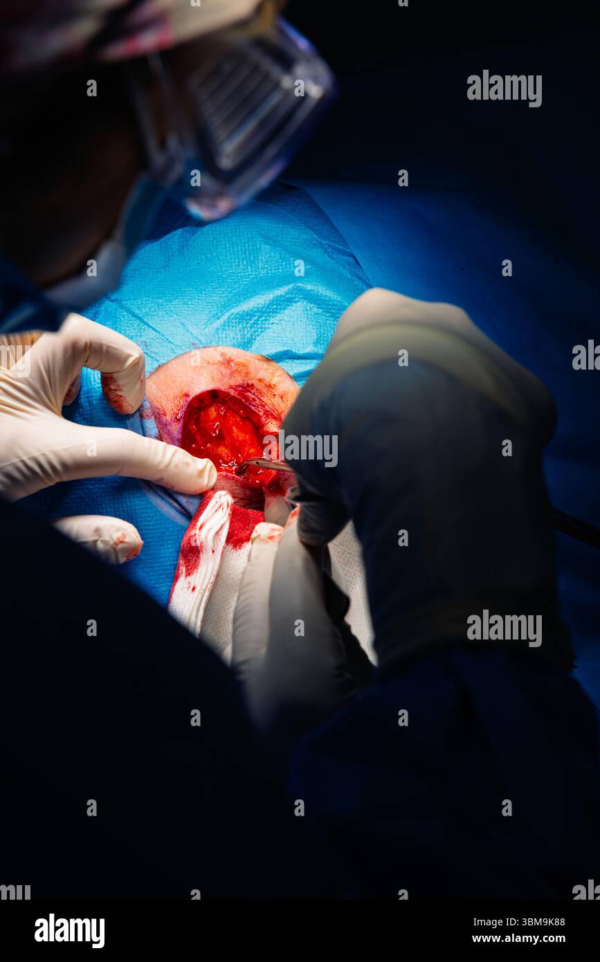 Chirurgie dermatologique au bloc opératoire. Coagulation des vaisseaux sanguins de la plaie chirurgicale. Carcinome épidermoïde. Les mains d'un chirurgien et salut Banque D'Images