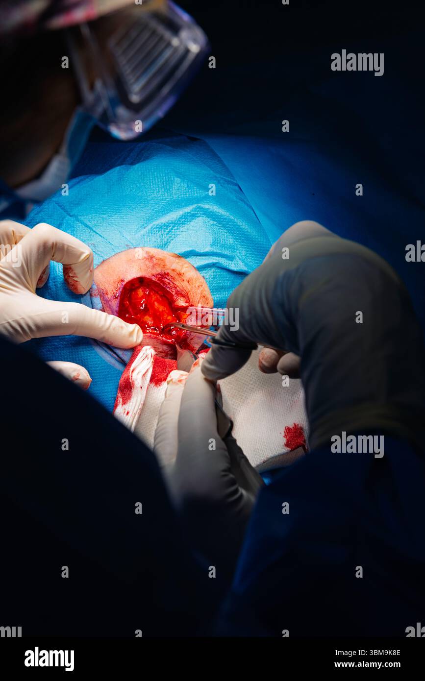 Chirurgie dermatologique au bloc opératoire. Coagulation des vaisseaux sanguins de la plaie chirurgicale. Carcinome épidermoïde. Les mains d'un chirurgien et salut Banque D'Images