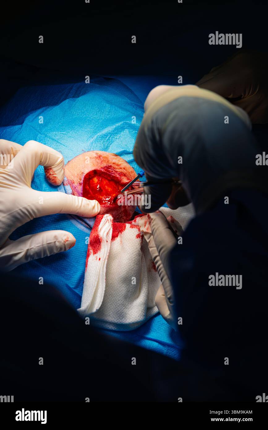 Chirurgie dermatologique au bloc opératoire. Coagulation des vaisseaux sanguins de la plaie chirurgicale. Carcinome épidermoïde. Les mains d'un chirurgien et salut Banque D'Images