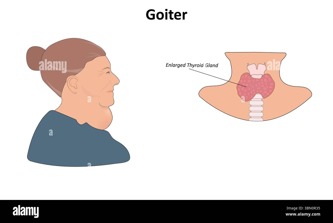 Illustration vectorielle du goitre (glande thyroïde élargie) Illustration de Vecteur
