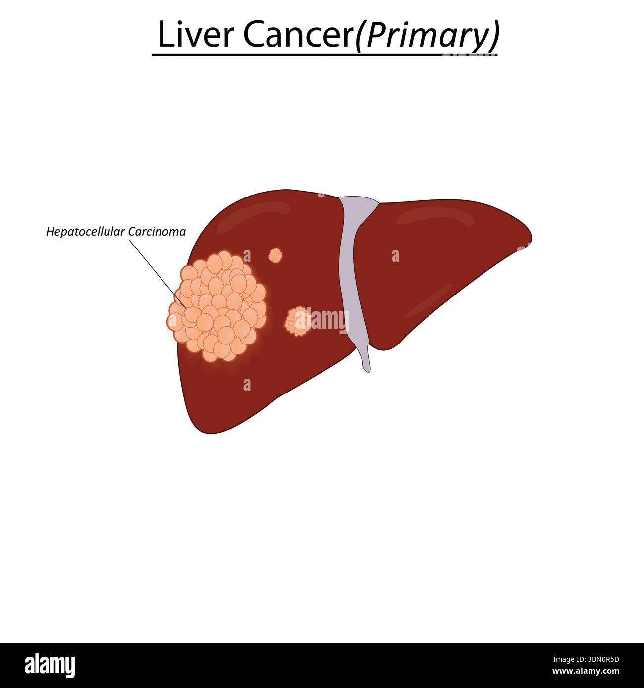 Carcinome hépatocellulaire (HCC), illustration vectorielle du cancer du foie Illustration de Vecteur