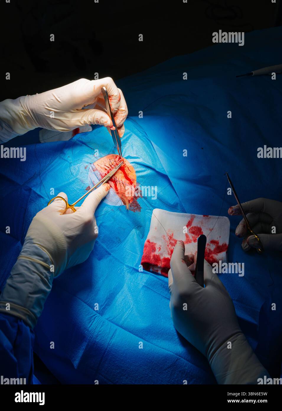 Chirurgie dermatologique au bloc opératoire. Finition de suture d'une plaie chirurgicale. Carcinome épidermoïde. Les mains d'un chirurgien et de son assistant int Banque D'Images