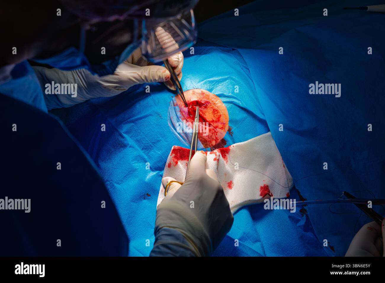 Chirurgie dermatologique au bloc opératoire. Suture d'une plaie chirurgicale. Carcinome épidermoïde. Les mains d'un chirurgien et son assista Banque D'Images