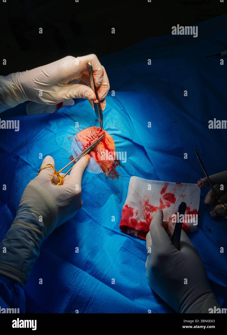Chirurgie dermatologique au bloc opératoire. Suture d'une plaie chirurgicale. Carcinome épidermoïde. Les mains d'un chirurgien et de son assistant intervenant Banque D'Images