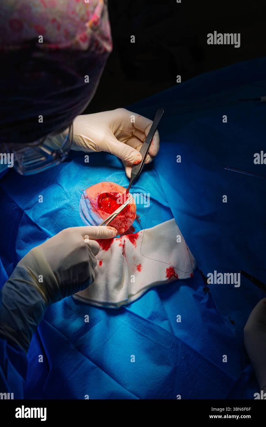 Chirurgie dermatologique au bloc opératoire. Suture d'une plaie chirurgicale. Carcinome épidermoïde. Les mains d'un chirurgien et son assista Banque D'Images