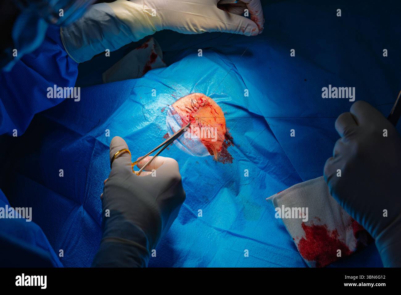 Chirurgie dermatologique en salle d'opération.suture chirurgicale avec exposition de l'artère temporale.carcinome épidermoïde.les mains d'un chirurgien et h. Banque D'Images