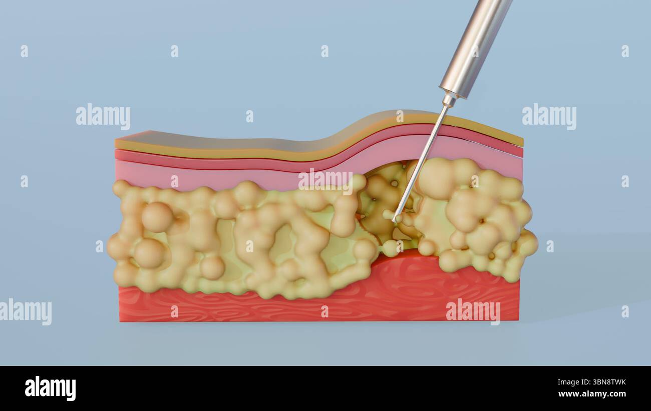 Un rendu 3D illustrant le processus de liposuccion, montrant spécifiquement une canule éliminant activement la graisse de la couche sous-cutanée. Banque D'Images