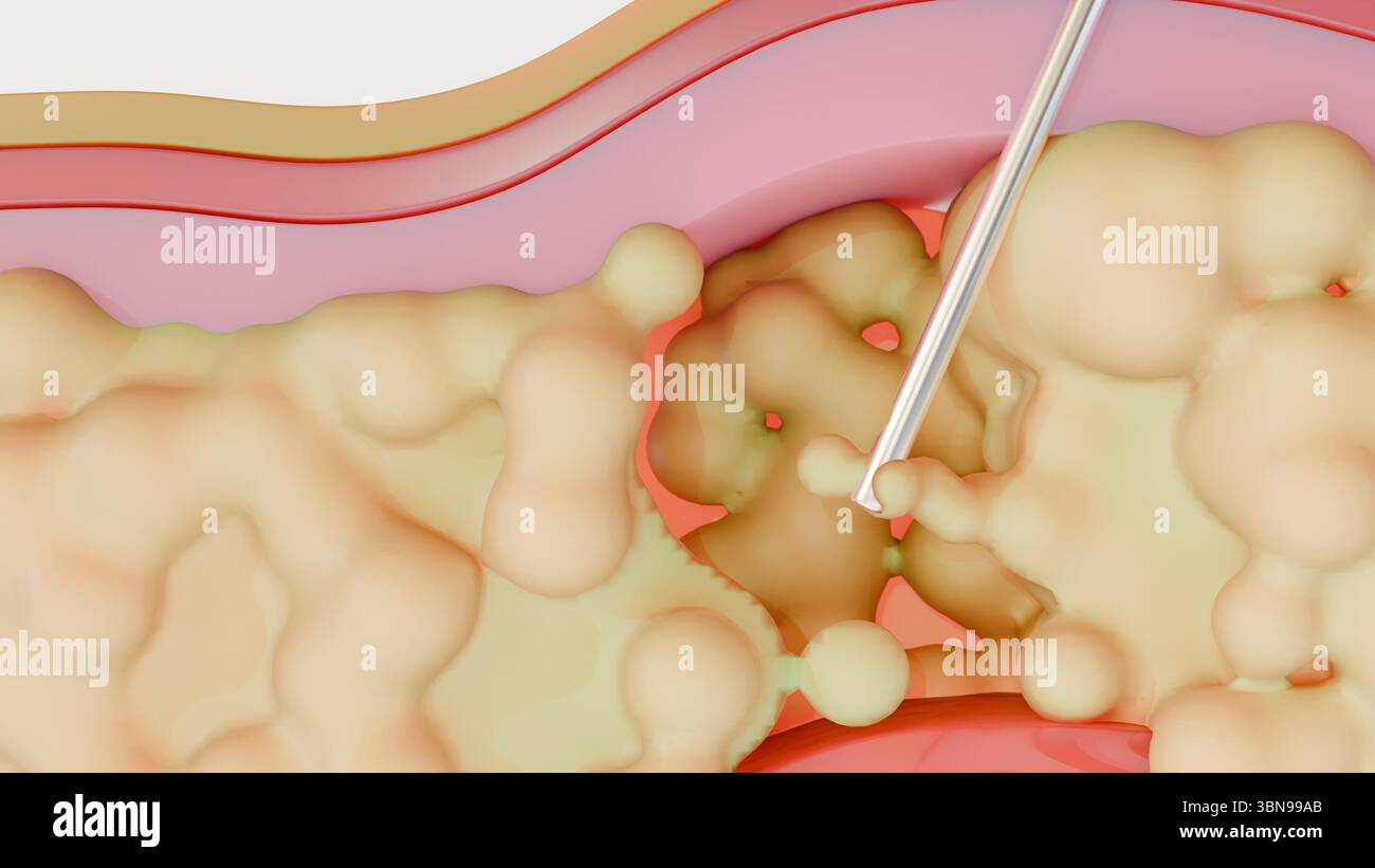 Un rendu 3D illustrant le processus de liposuccion, montrant spécifiquement une canule éliminant activement la graisse de la couche sous-cutanée. Banque D'Images