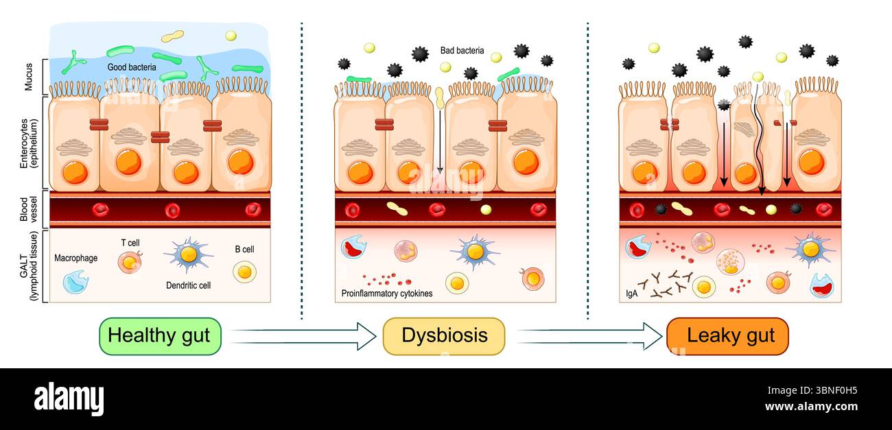 Intestin qui fuit. Évolution de l'intestin sain vers la dysbiose et la perméabilité intestinale. Gros plan des cellules d'un épithélium intestinal. Affiche vectorielle détaillée Illustration de Vecteur