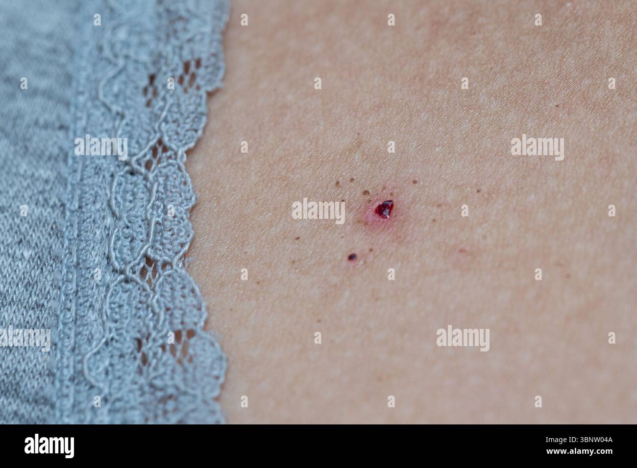 Gros plan d’une éruption douloureuse avec cloques provoquant des démangeaisons et une sensation de brûlure Banque D'Images Gros plan d’une éruption douloureuse avec cloques provoquant des démangeaisons et une sensation de brûlure Banque D'Images