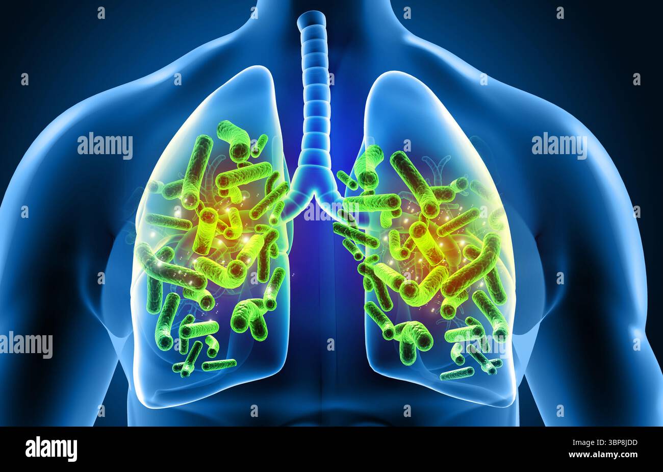 Poumons humains infectés par virus et bactéries. Anatomie des poumons. illustration 3d. Banque D'Images