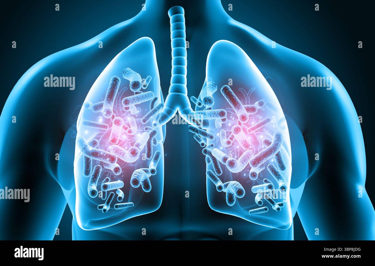 Poumons humains infectés par virus et bactéries. Anatomie des poumons. illustration 3d. Banque D'Images