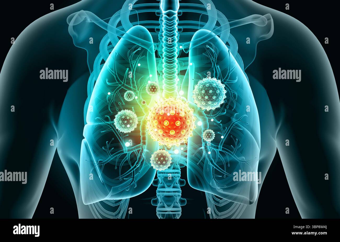 Poumons humains infectés par virus et bactéries. Anatomie des poumons. illustration 3d. Banque D'Images