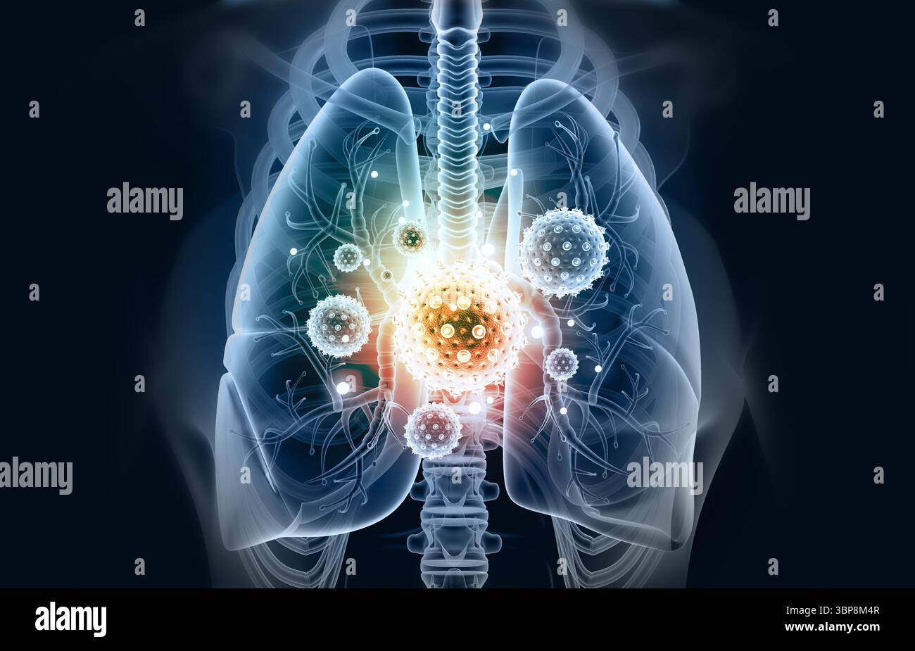 Poumons humains infectés par virus et bactéries. Anatomie des poumons. illustration 3d. Banque D'Images