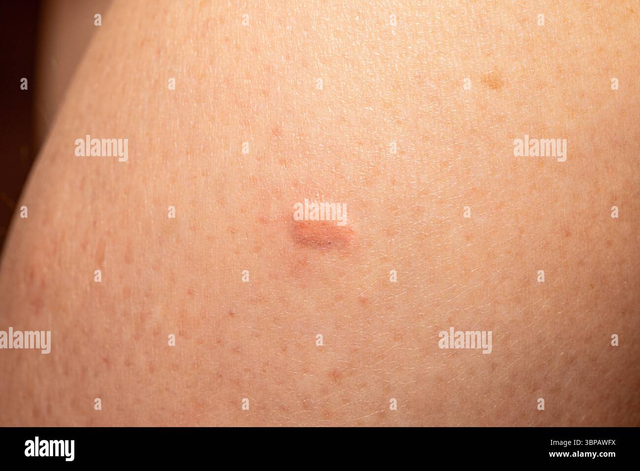 Tissu cicatriciel chéloïde se développant sur la peau après un traumatisme, créant une surface irrégulière surélevée souvent de couleur rose ou rouge Banque D'Images