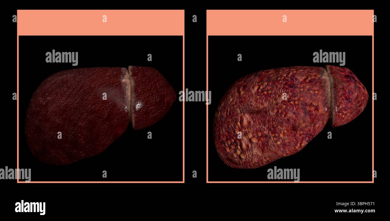 Cette illustration 3d montre la comparaison entre un foie sain et un foie atteint de cirrhose Banque D'Images