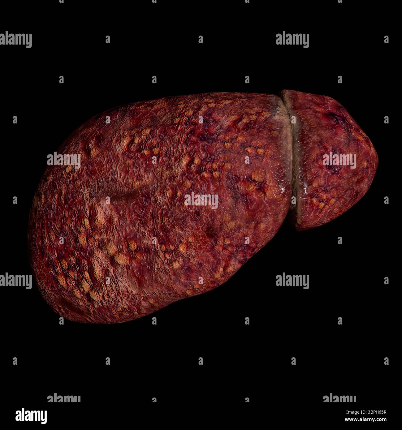 Il s'agit d'une illustration 3d montrant le foie humain atteint de cirrhose Banque D'Images