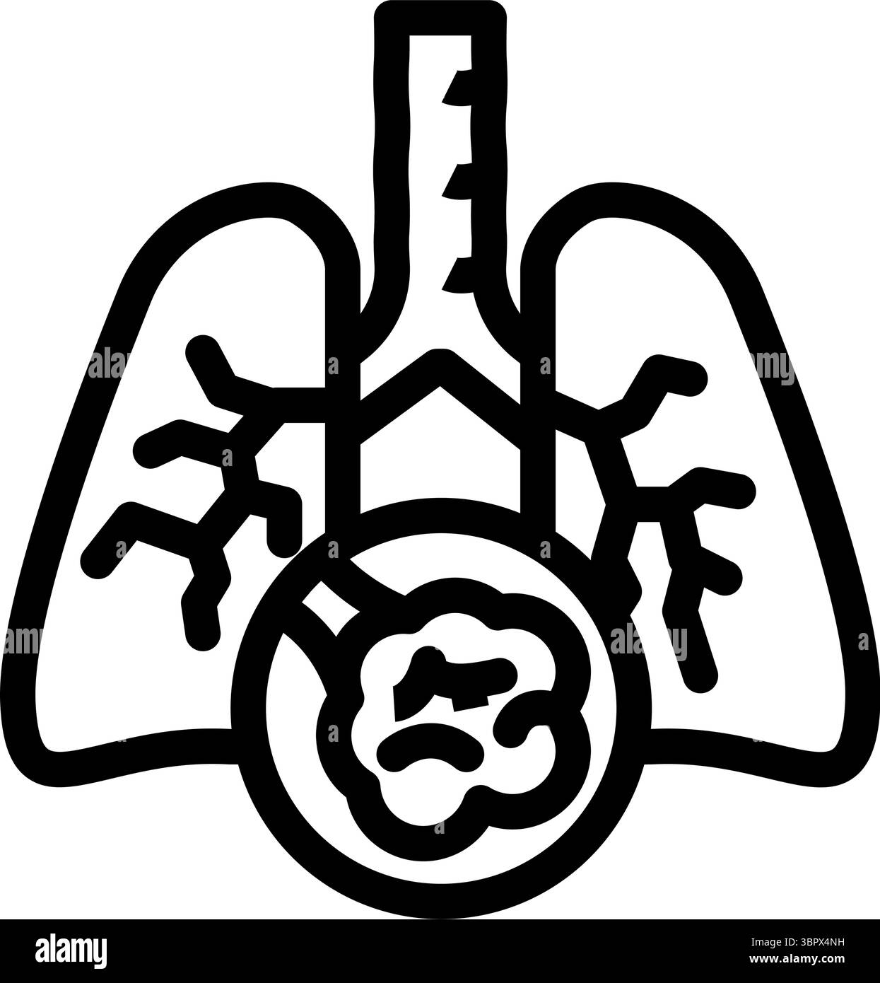 Fibrose pulmonaire Banque d'images vectorielles - Alamy