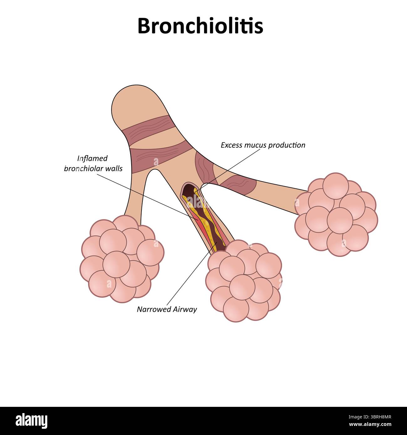 Illustration vectorielle de bronchiolite Illustration de Vecteur