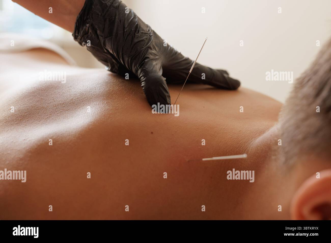 Gros plan d'une séance d'aiguilletage à sec pour le soulagement de la douleur musculaire et la rééducation, effectuée par un thérapeute professionnel Banque D'Images