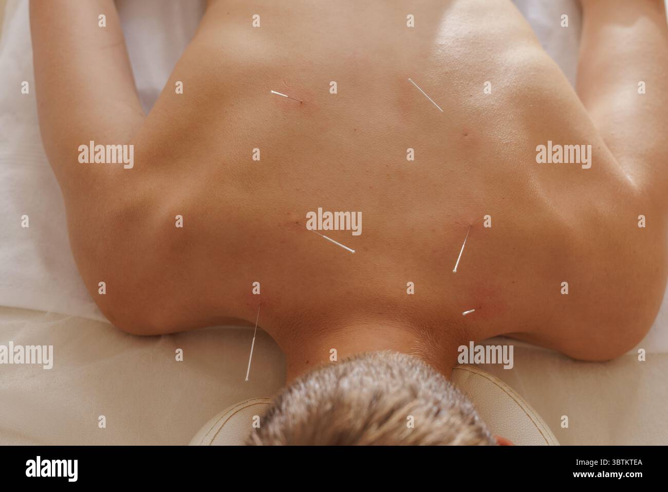 Vue rapprochée de la séance d'aiguilletage à sec avec plusieurs aiguilles pour soulager la douleur et le traitement de réadaptation musculaire Banque D'Images