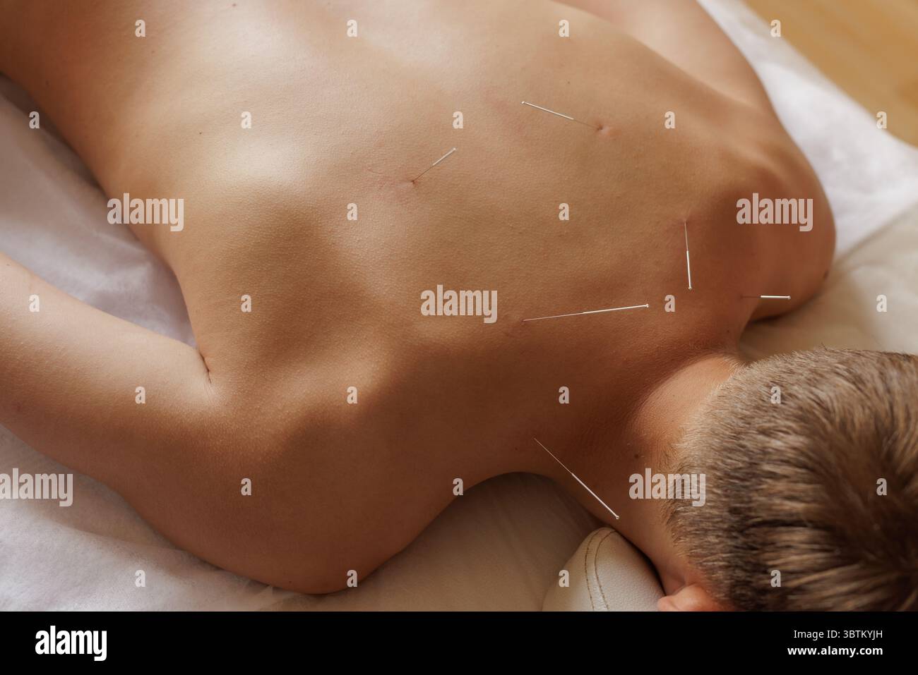 Gros plan de la procédure d'aiguilletage sec pour le soulagement de la douleur et la thérapie musculaire dans la physiothérapie moderne et la réadaptation Banque D'Images