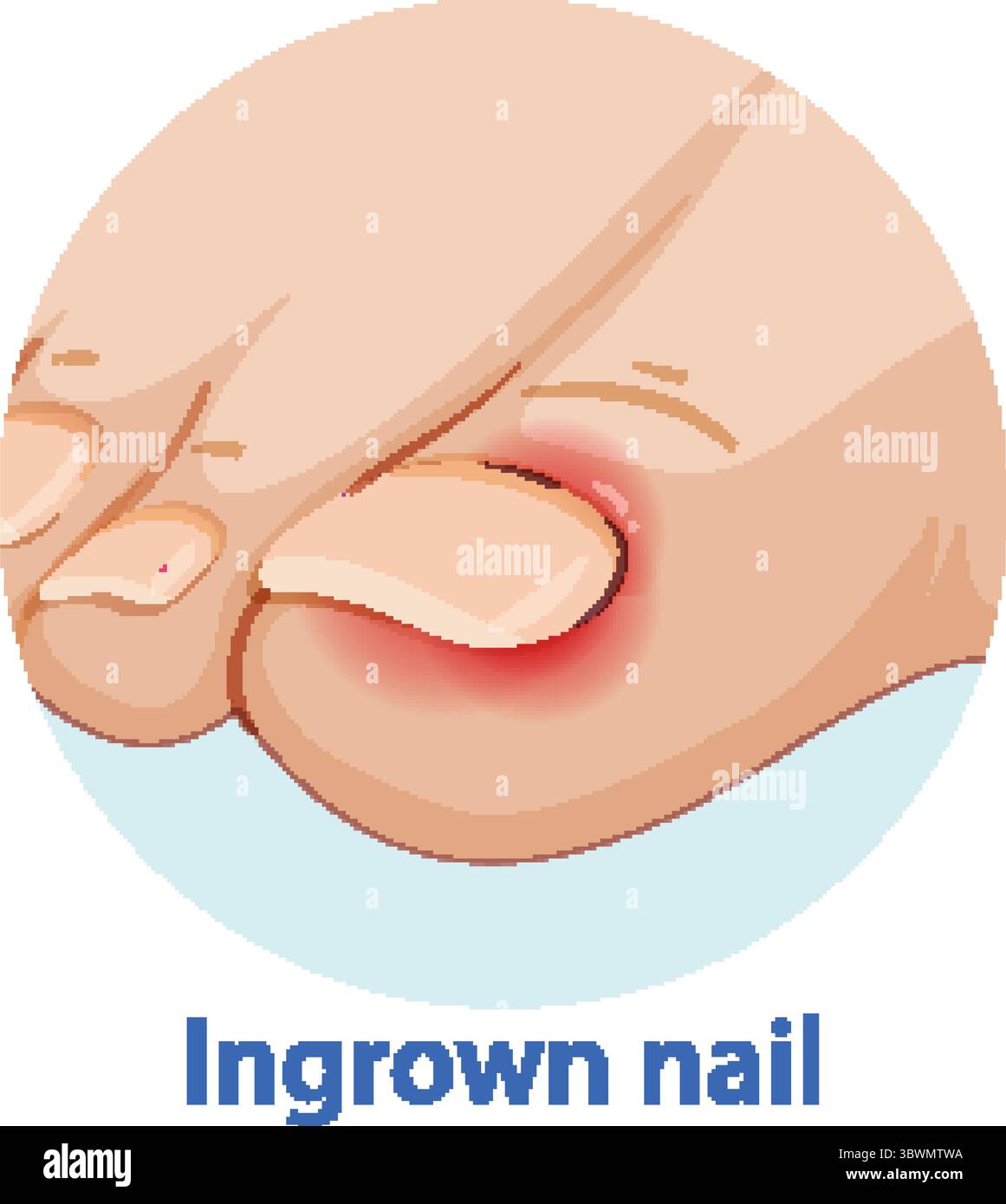 Illustration vectorielle montrant un gros plan d'un orteil humain avec un ongle incarné enflammé, design plat, palette de couleurs douces, contexte médical Illustration de Vecteur