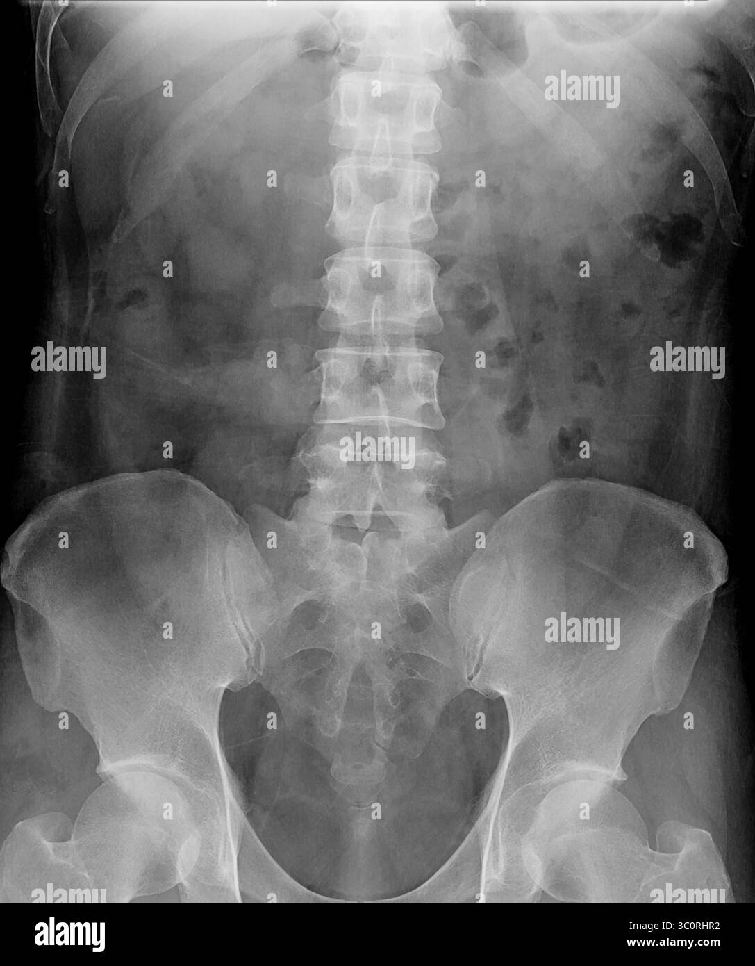 Radiographie de l'abdomen, montrant une imagerie claire des organes digestifs et des structures environnantes, sans anomalies ou obstructions visibles. Banque D'Images